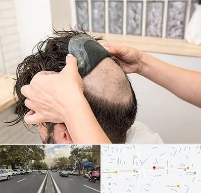 پروتز مو در دولت 