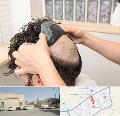 پروتز مو در نواب اسلامشهر