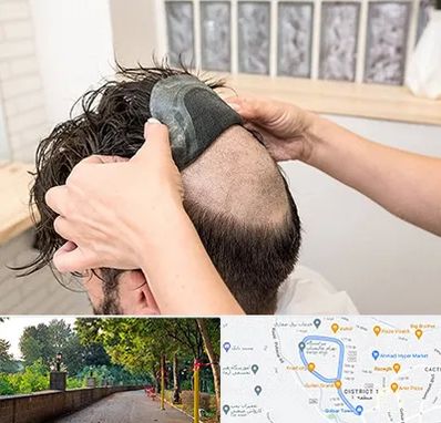 پروتز مو در فلکه گاز رشت 