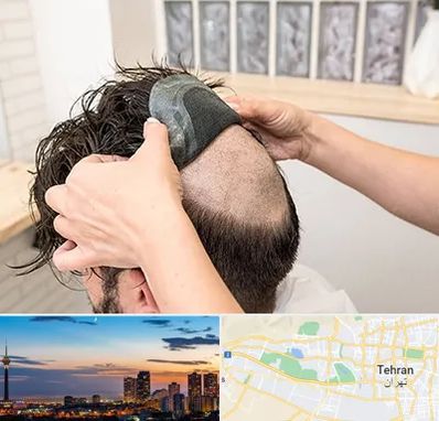 پروتز مو در غرب تهران 