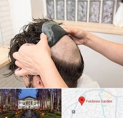 پروتز مو در باغ فردوس