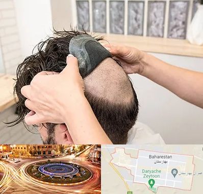 پروتز مو در بهارستان