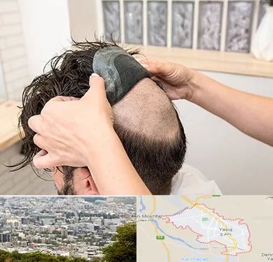 پروتز مو در یاسوج