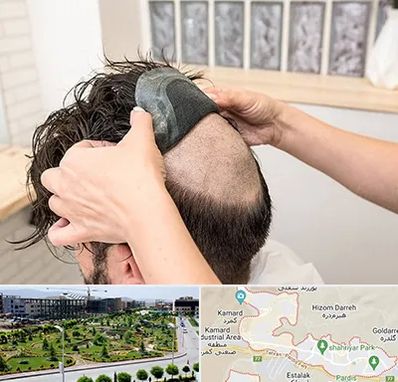 پروتز مو در پردیس