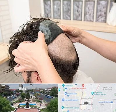 پروتز مو در بهارستان 