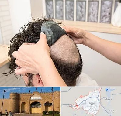 پروتز مو در ایرانشهر