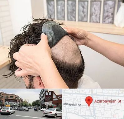 پروتز مو در خیابان آذربایجان