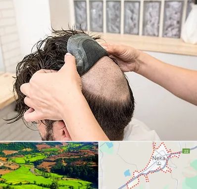پروتز مو در نکا