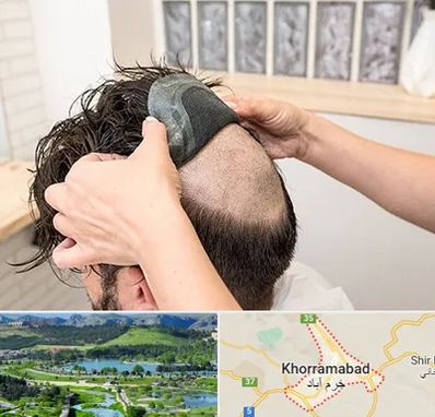 پروتز مو در خرم آباد