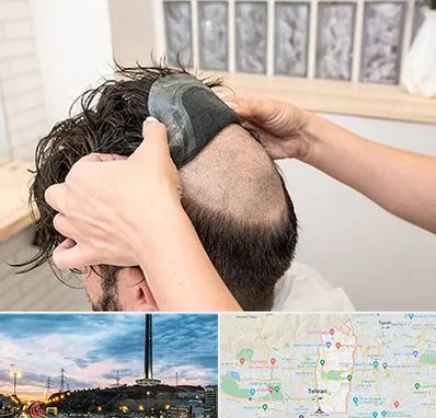 پروتز مو در منطقه 2 تهران 