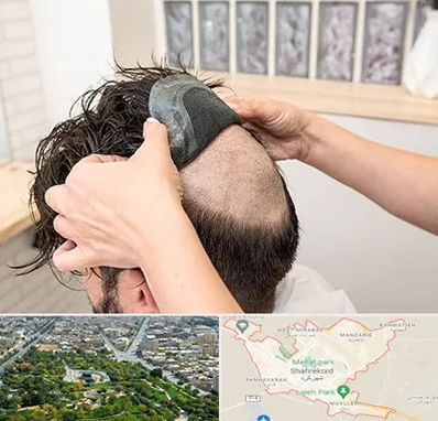 پروتز مو در شهرکرد