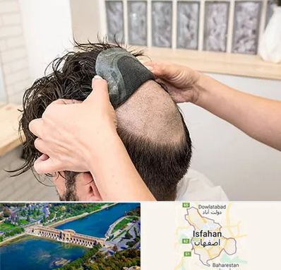 پروتز مو در اصفهان