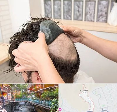 پروتز مو در درکه