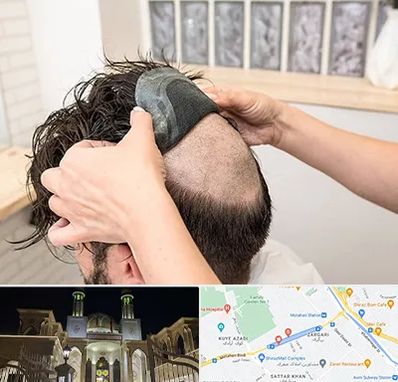 پروتز مو در زرگری شیراز 