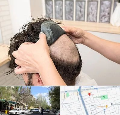 پروتز مو در کوی فیروز تبریز