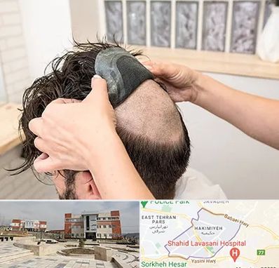 پروتز مو در حکیمیه 