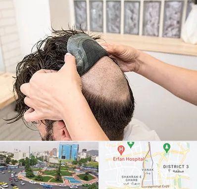 پروتز مو در ونک 