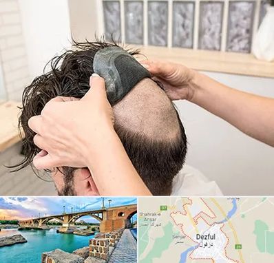 پروتز مو در دزفول