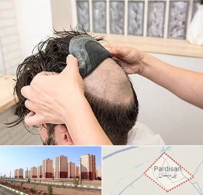 پروتز مو در پردیسان قم