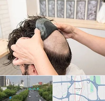 پروتز مو در توانیر