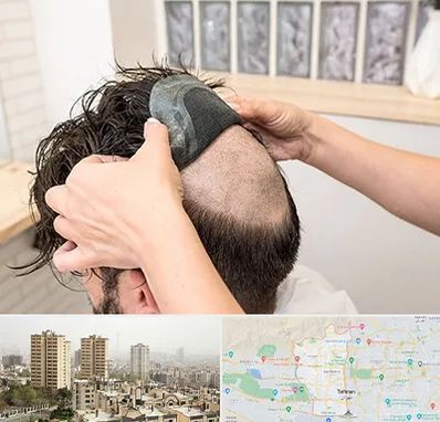 پروتز مو در منطقه 5 تهران 