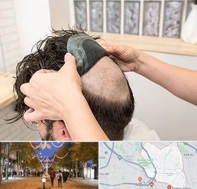 پروتز مو در ولیعصر ارومیه