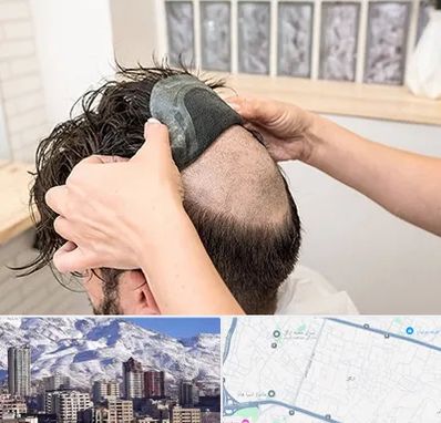 پروتز مو در ازگل