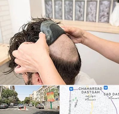 پروتز مو در چهارصد دستگاه 