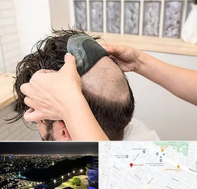 پروتز مو در هفت تیر مشهد 