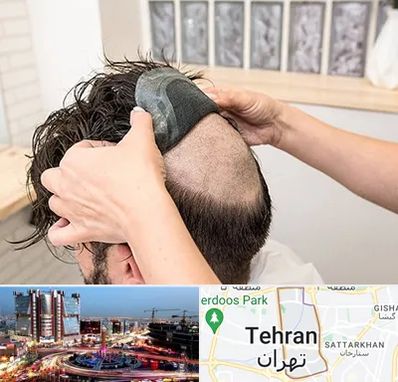 پروتز مو در صادقیه 