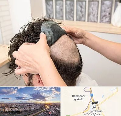پروتز مو در قم