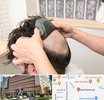 پروتز مو در سهروردی 