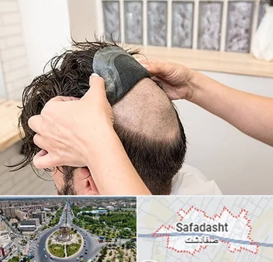 پروتز مو در صفادشت
