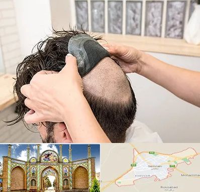 پروتز مو در سمنان