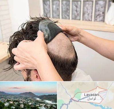 پروتز مو در لواسان