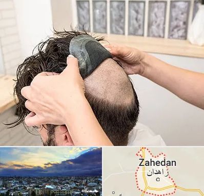 پروتز مو در زاهدان