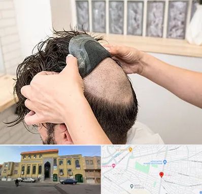 پروتز مو در زنبیل آباد قم