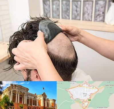 پروتز مو در خوی