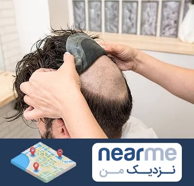 پروتز مو در نزدیک من