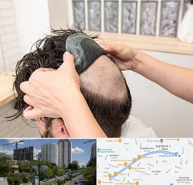 پروتز مو در اندرزگو 