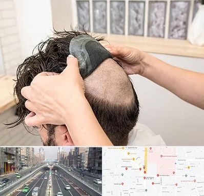 پروتز مو در توحید 