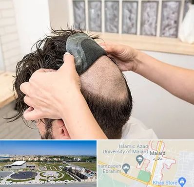 پروتز مو در ملارد