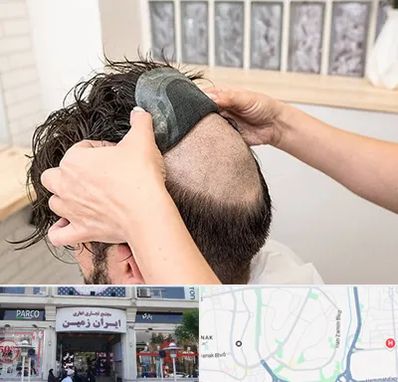 پروتز مو در ایران زمین