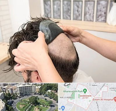 پروتز مو در جهانشهر کرج 