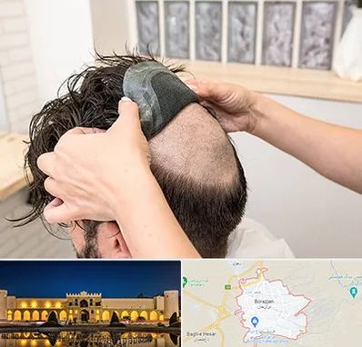 پروتز مو در برازجان