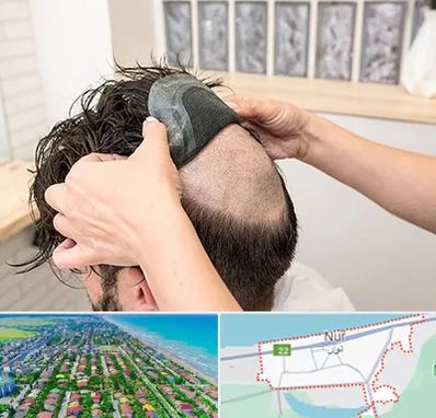 پروتز مو در نور