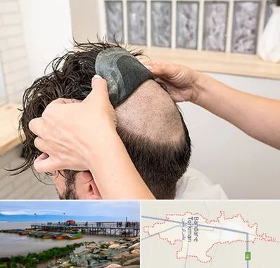 پروتز مو در بندر ترکمن