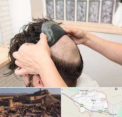 پروتز مو در بم