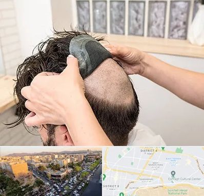 پروتز مو در تهرانپارس 