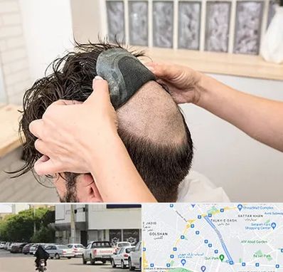 پروتز مو در قدوسی شرقی شیراز